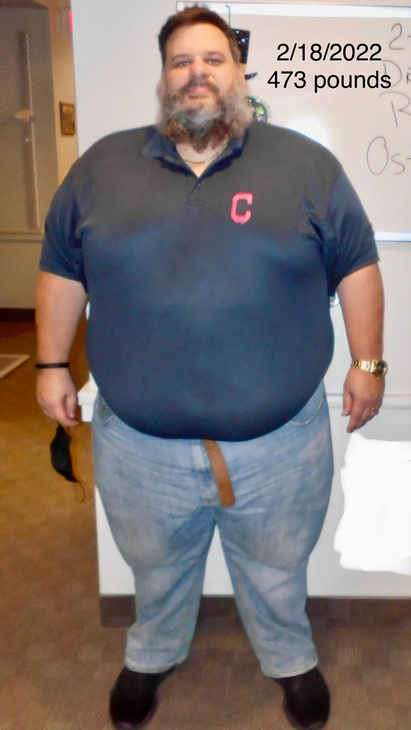 Patient Testimonial Rob O Before Gastric Sleeve Surgery