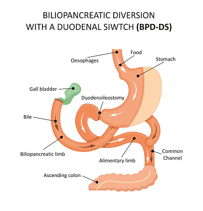 Illustration of Biliopancreatic Diversion with a Duodenal Switch (BPD-DS)