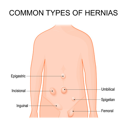 Illustration of Common Types of Hernia