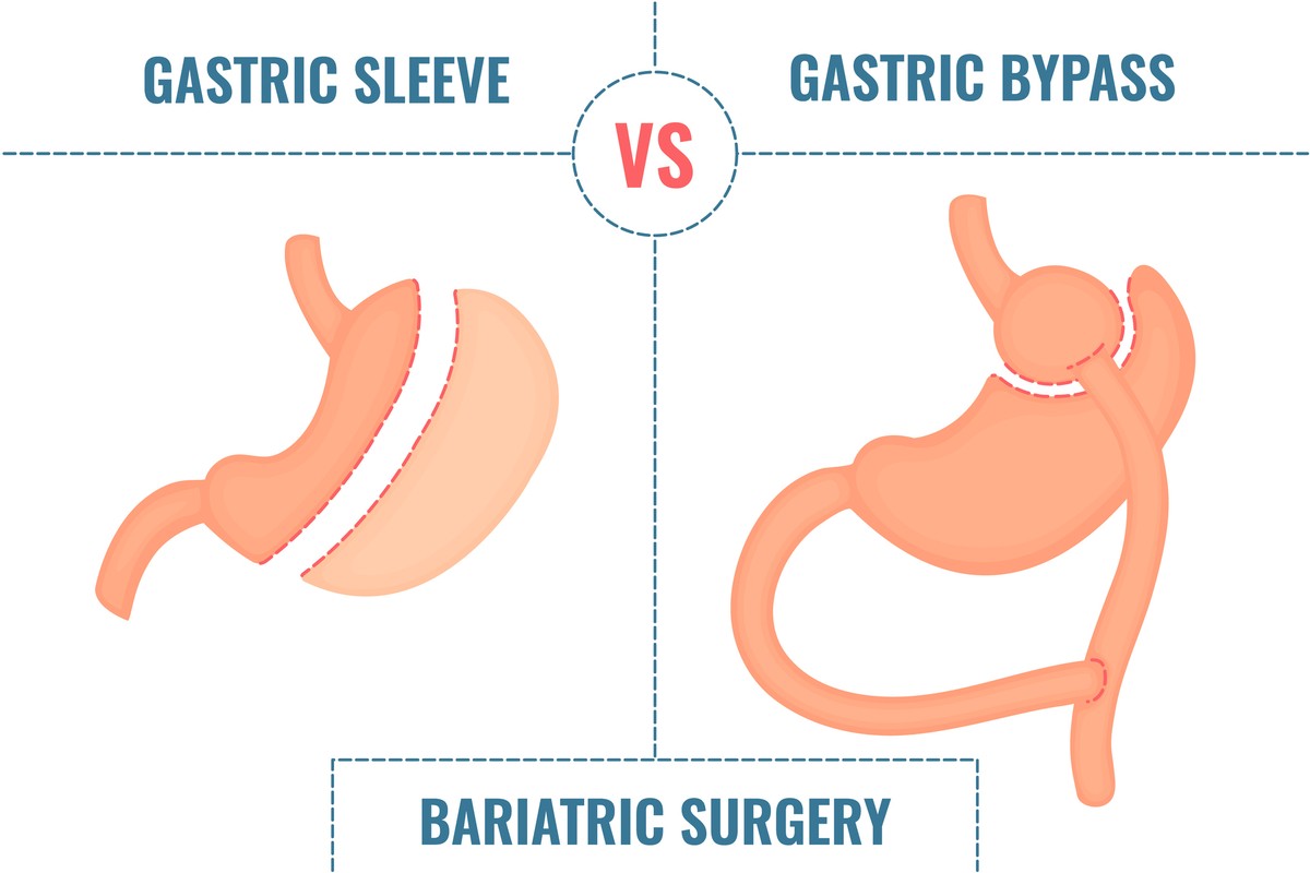 Gastric Sleeve Surgery in North Canton & Middleburg, OH