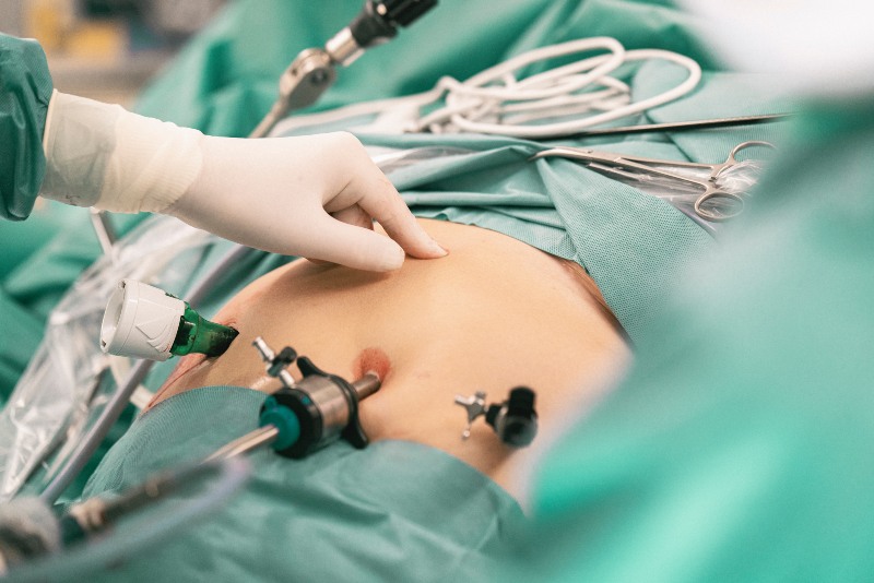 Laparoscopic instruments on stomach of patient. Surgeons performing bariatric surgery in operating room.