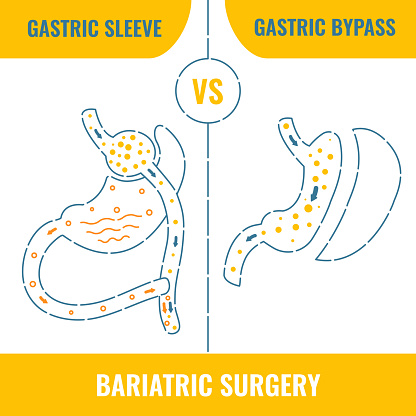 An Anatomical Infographic on Stomach Reduction of Gastric Sleeve Vs Gastric Bypass Surgery